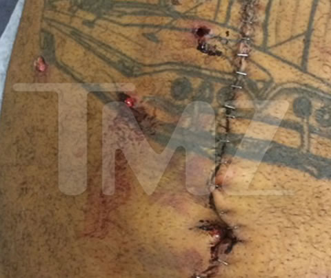恐怖的6枪子弹打过Tuapc前老板Suge Knight身体手术后照片..非常刺激神经 (6张照片)