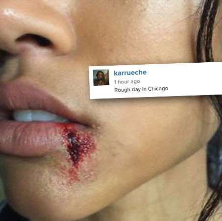 发生什么了? Chris Brown前女友Karrueche嘴角被打伤出血了看起来很严重.. (照片) 
