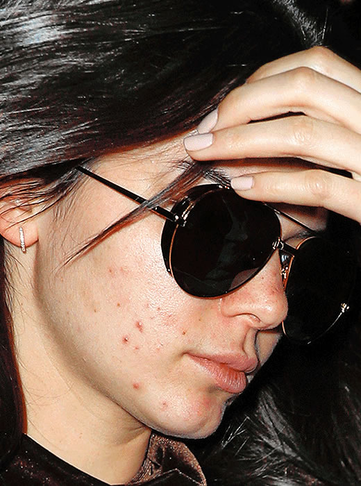 尴尬..Kendall Jenner这么差的皮肤状况被狗仔抓拍曝光 (照片)
